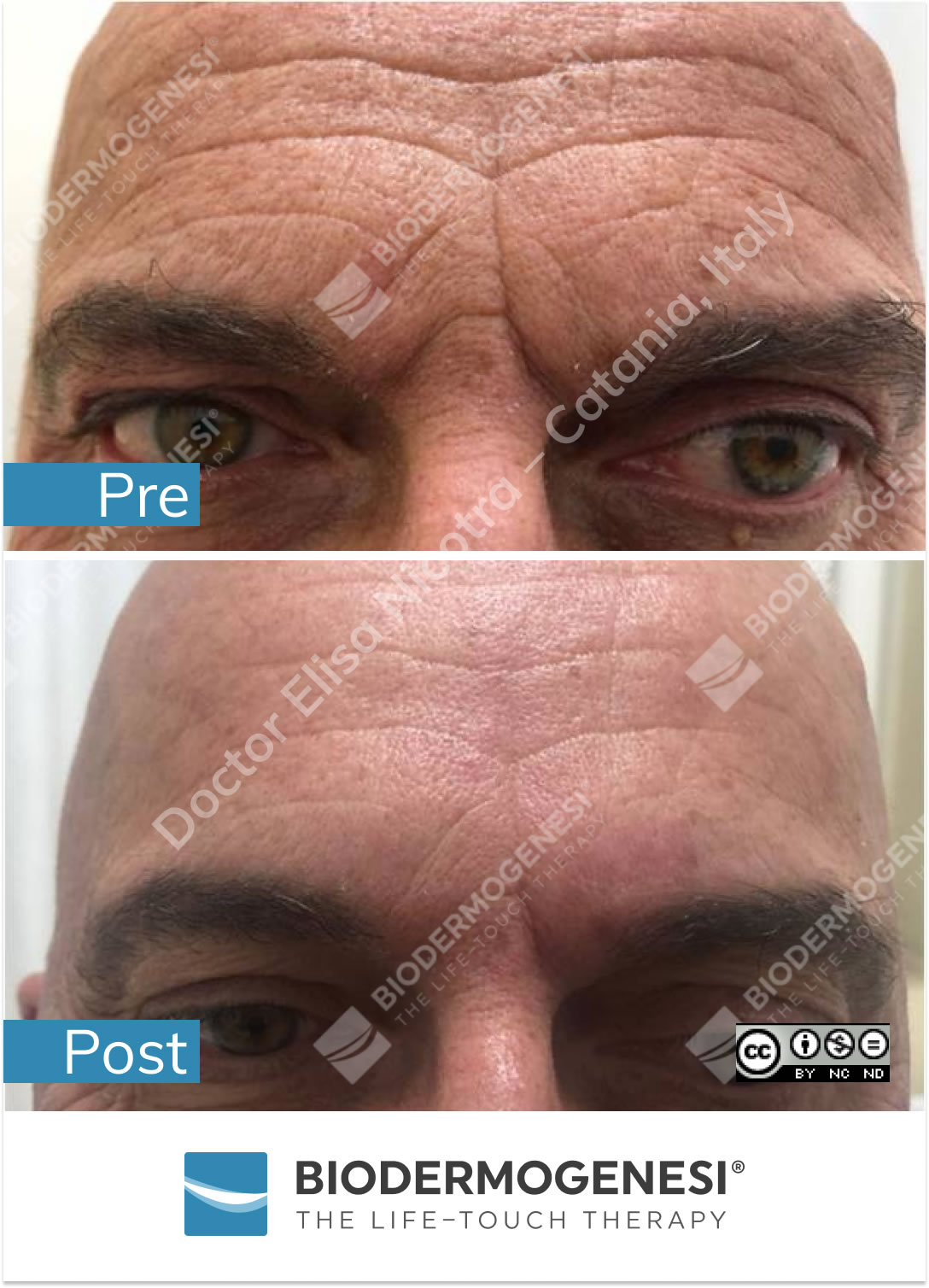 Trattamento AntiAging