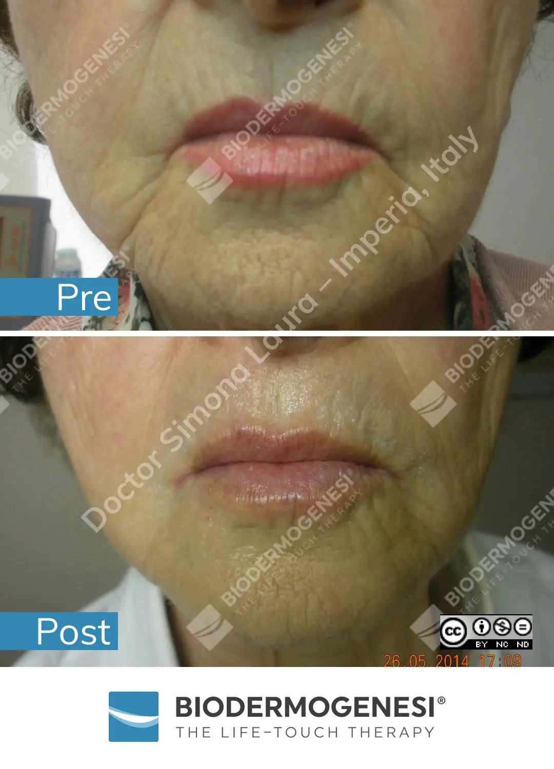 Trattamento AntiAging