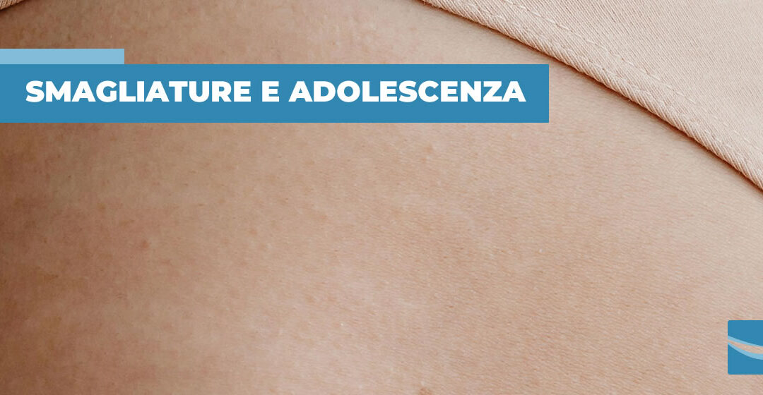 Le smagliature ed i ragazzi adolescenti